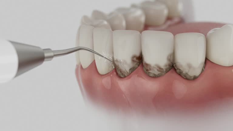 Trusted Wisdom Tooth Removal service in Ball Ground, GA - Dentist Open Now